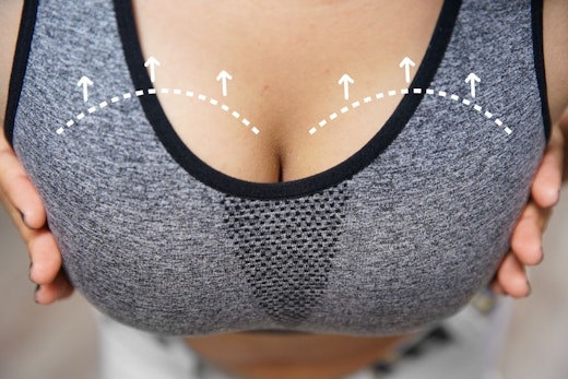 arrows indicating a breast lift