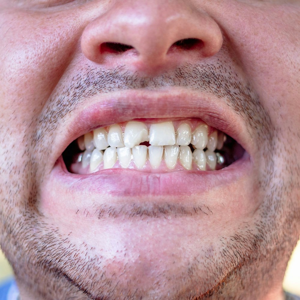 Man's chipped tooth in need of dental bonding