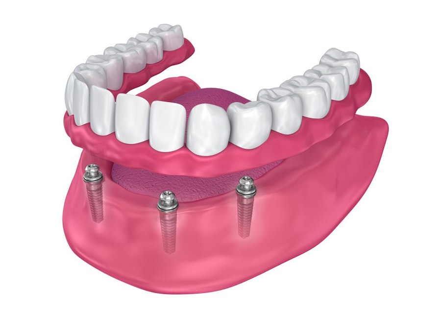 Dental Braces Treatment: Procedure, Cost, Recovery, Side Effects