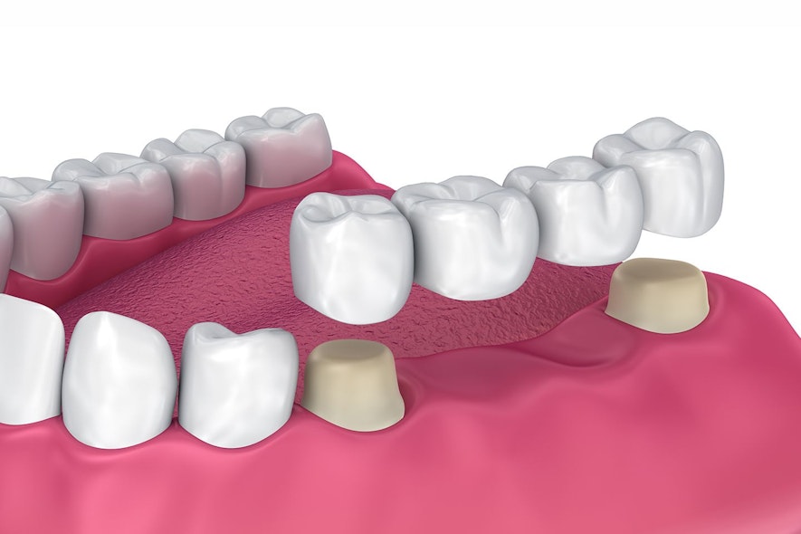 Illustration of dental bridge