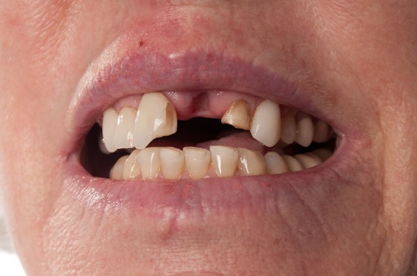 Severely damaged front teeth