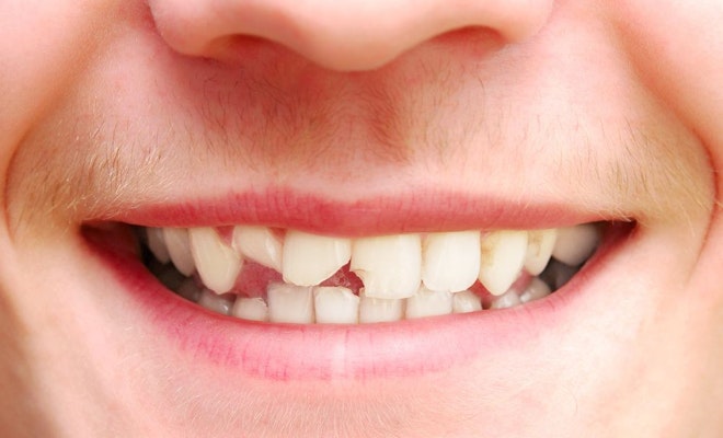 Broken Teeth