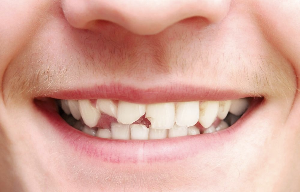 Person with broken teeth