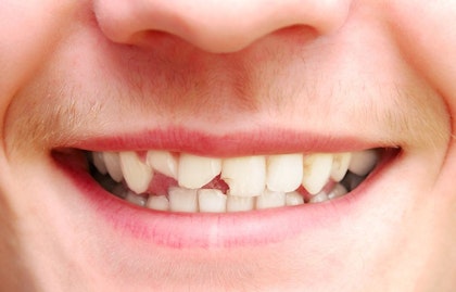 Image of broken teeth