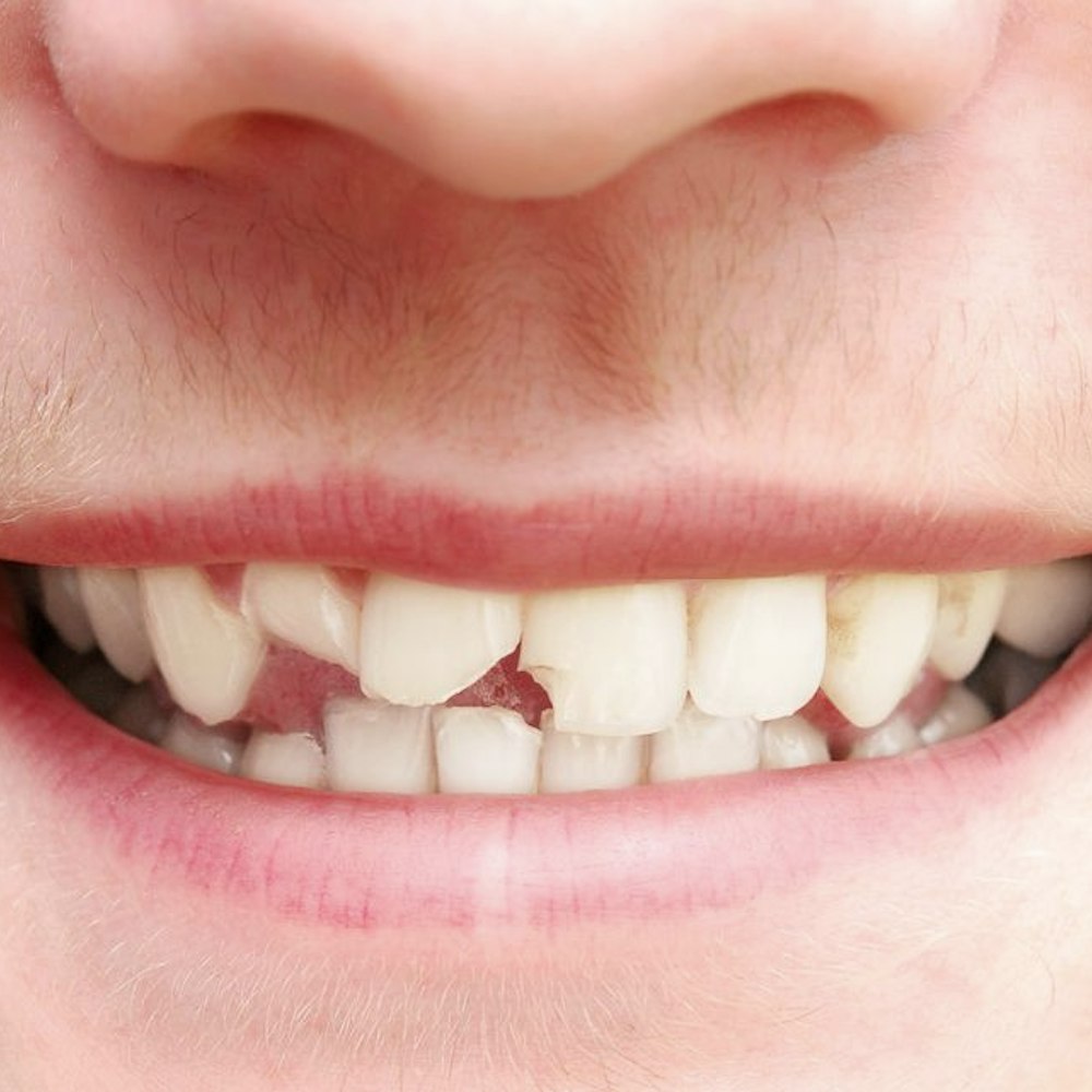 Person with broken teeth