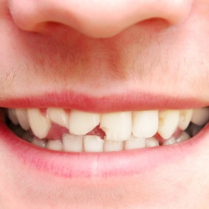 Image of broken teeth