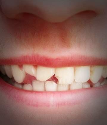 Person with damaged teeth