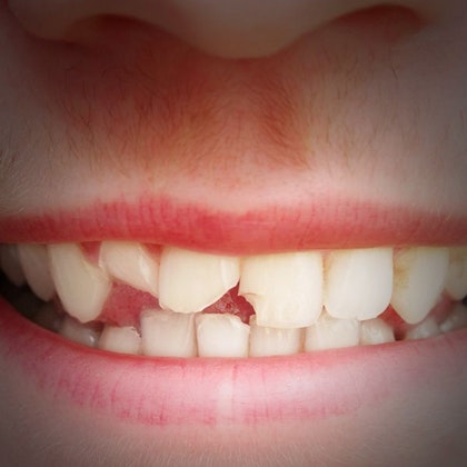 Person with damaged teeth