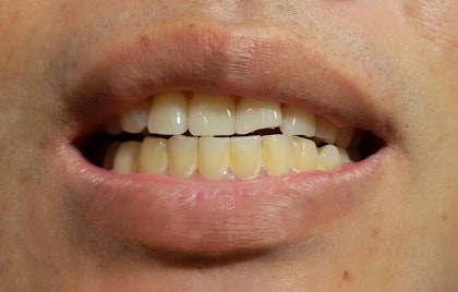 stained, yellowed teeth