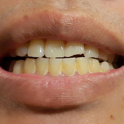 stained, yellowed teeth