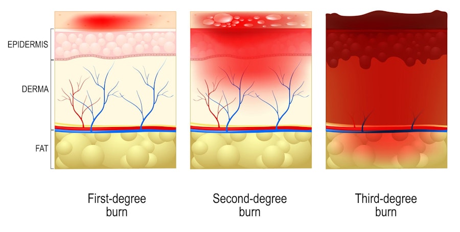 Illustration demonstrating the extent of first-, second-, and third-degree burns.