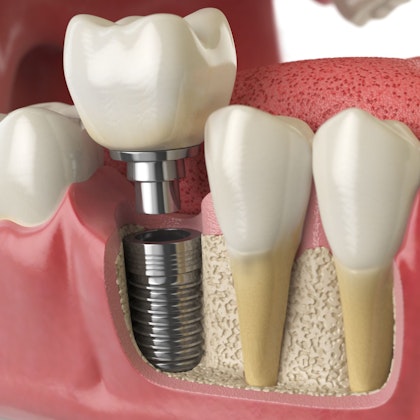 Implant-Supported Crowns