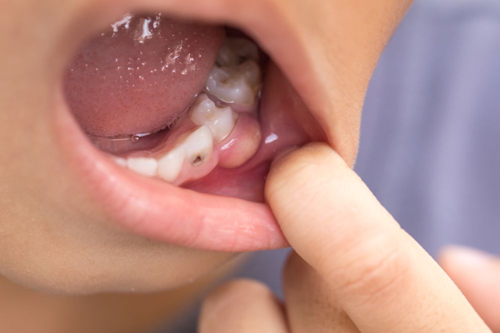 Swollen gum behind back tooth no wisdom teeth online