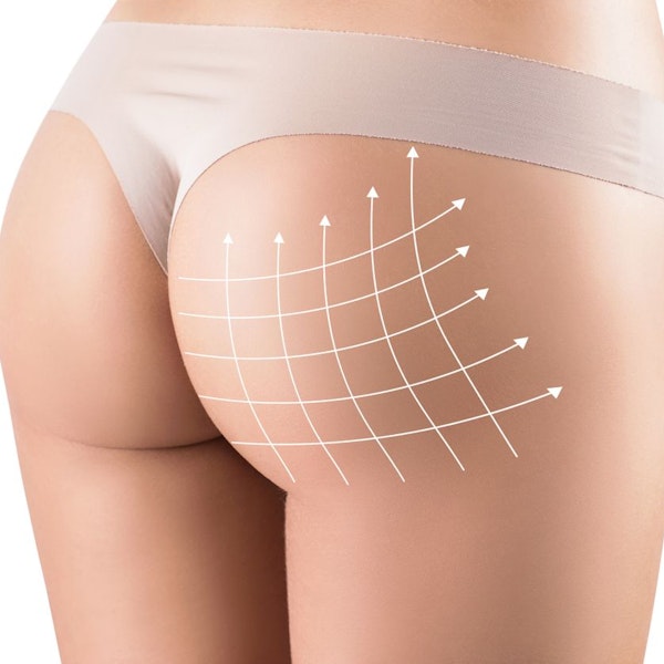 Brazilian butt lift diagram