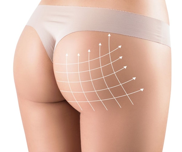 Brazilian butt lift diagram
