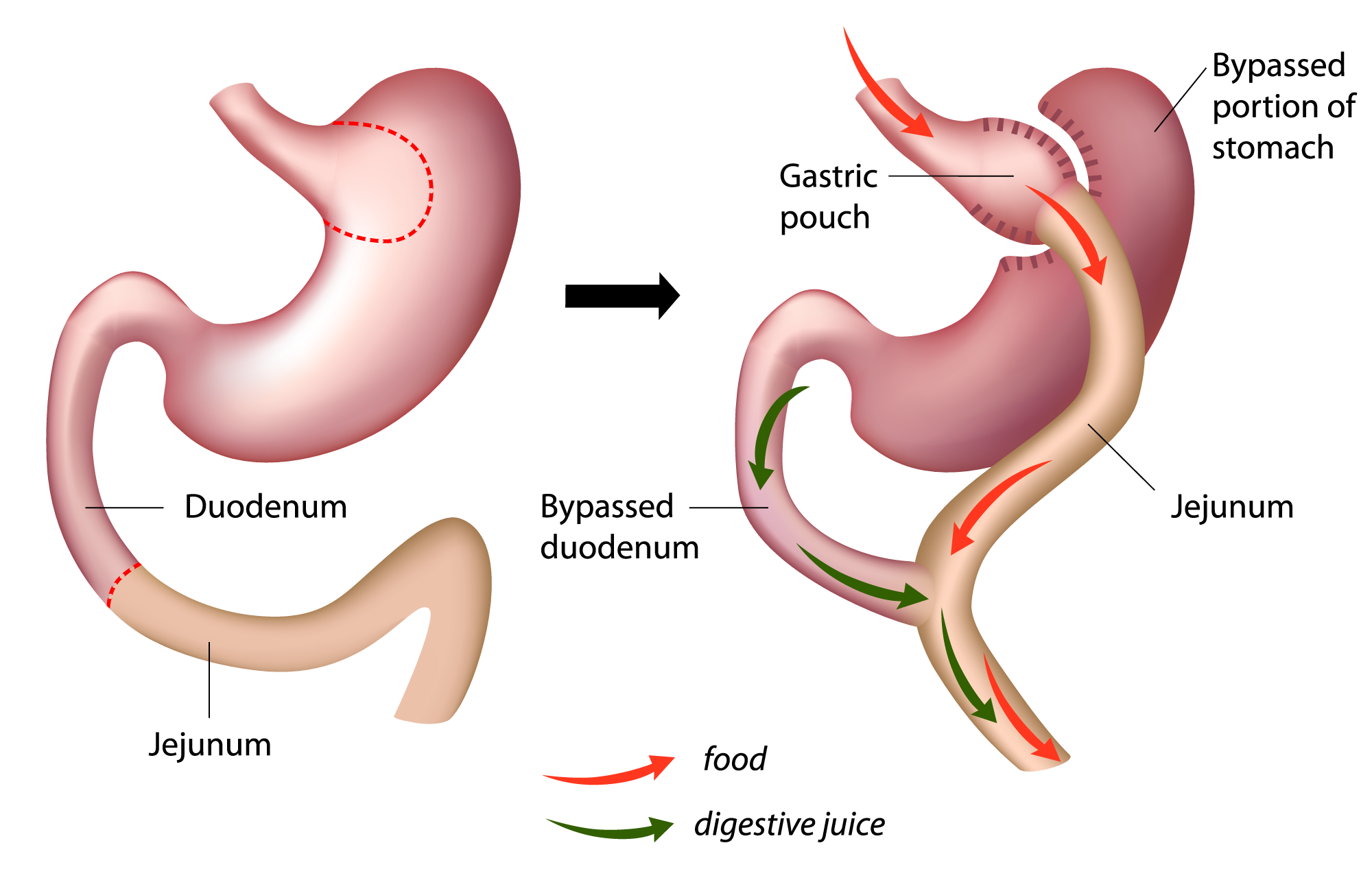 Roux-en-y diagram