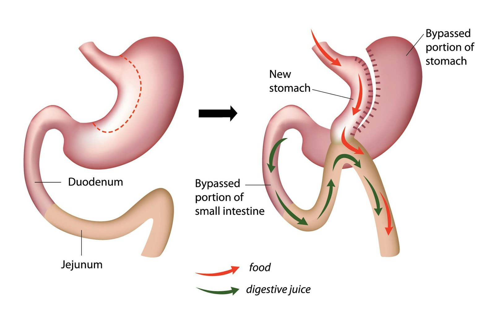Before and after mini gastric bypass where a new stomach is created and connected to the jejunum. The bypassed portion of the stomach has digestive juice flowing to the jejunum while the new stomach has food flowing to the jejunum.