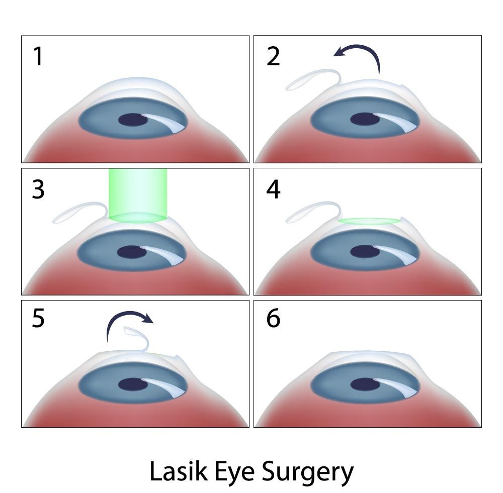 Six stages of Lasik Eye Surgery