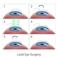 LASIK Cost Chicago IL Midway Garfield Ridge Primary Eye Care 