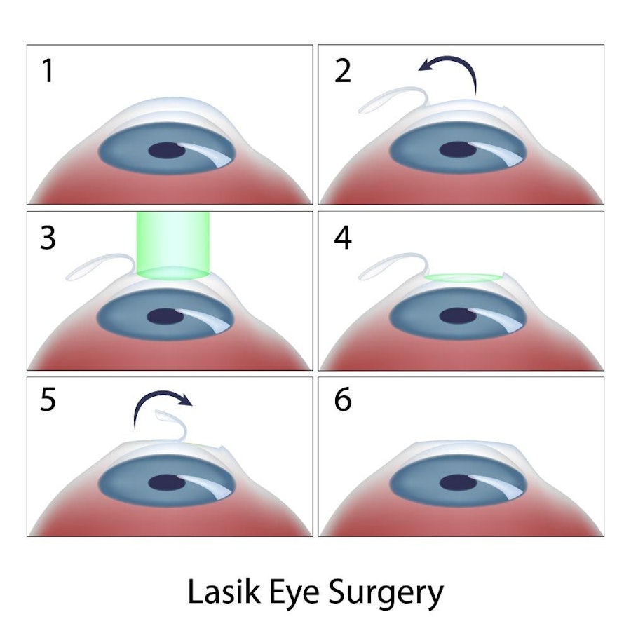 lasik surgery