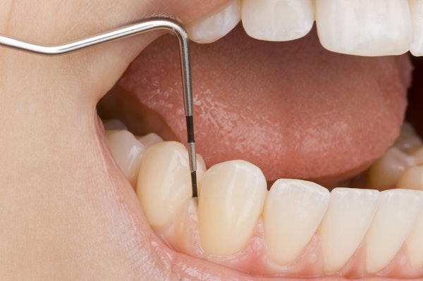 Woman's straight, white teeth being examined by dental mirror