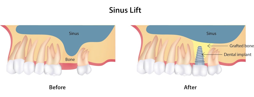 A before and after illustration of how a sinus lift can add bone to the upper molar area