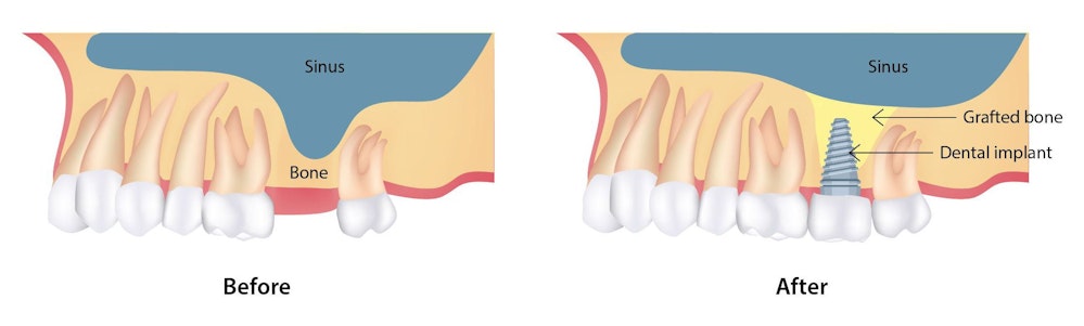 Diagram comparing density of upper jawbone before and after a sinus lift.