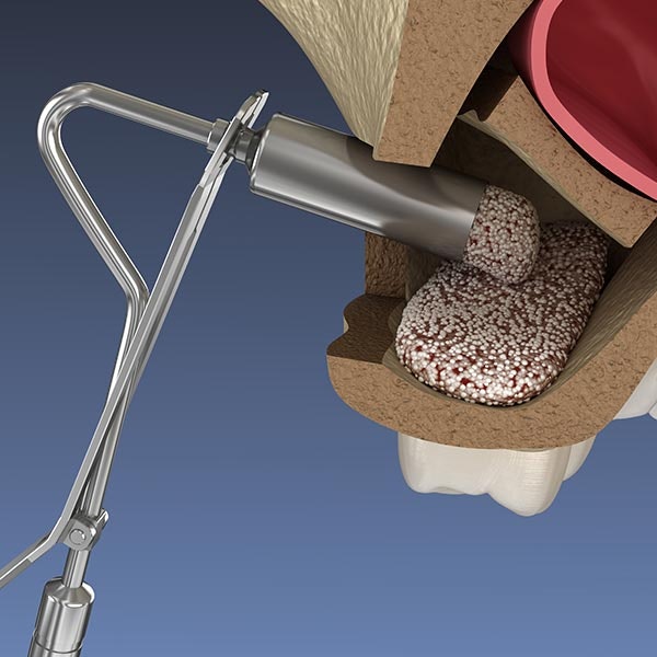 Sinus lift illustration