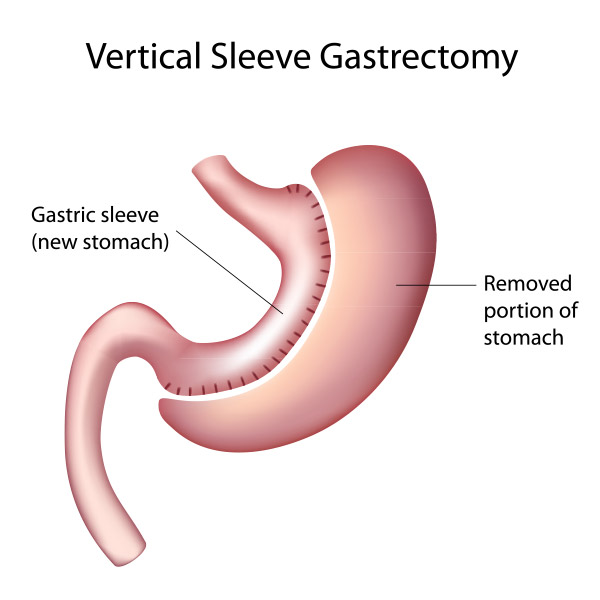 Illustration of gastric sleeve