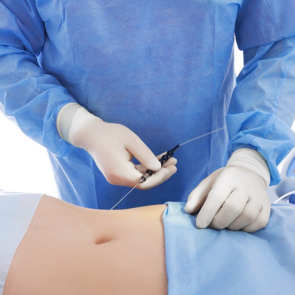Tumescent Liposuction