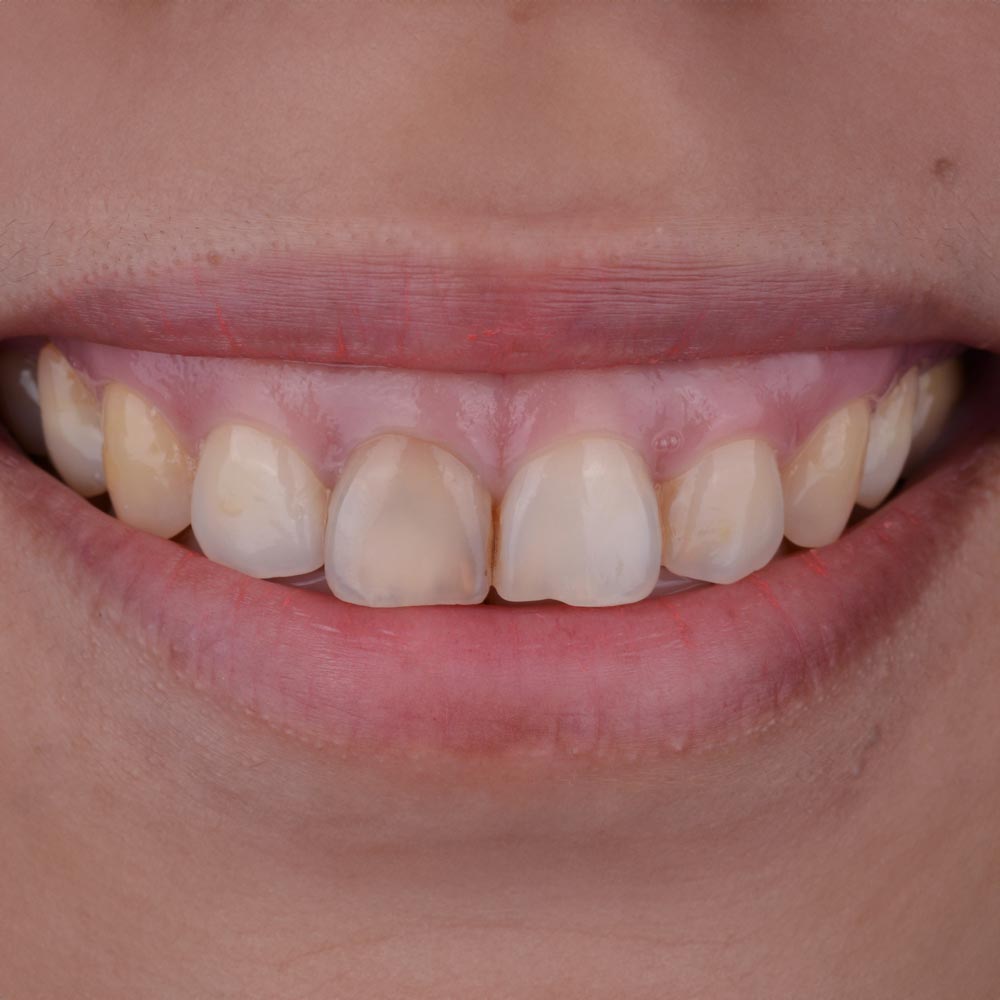 Gummy smile