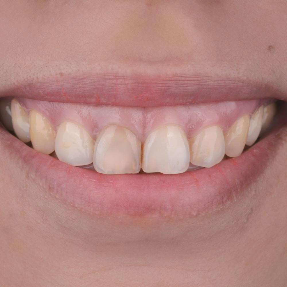 Gummy smile