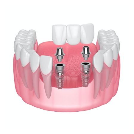 Dental implant bridge