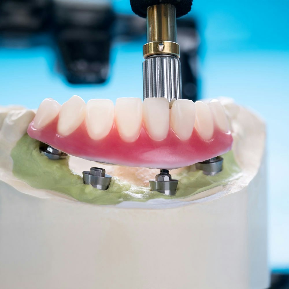 All-on-4 denture