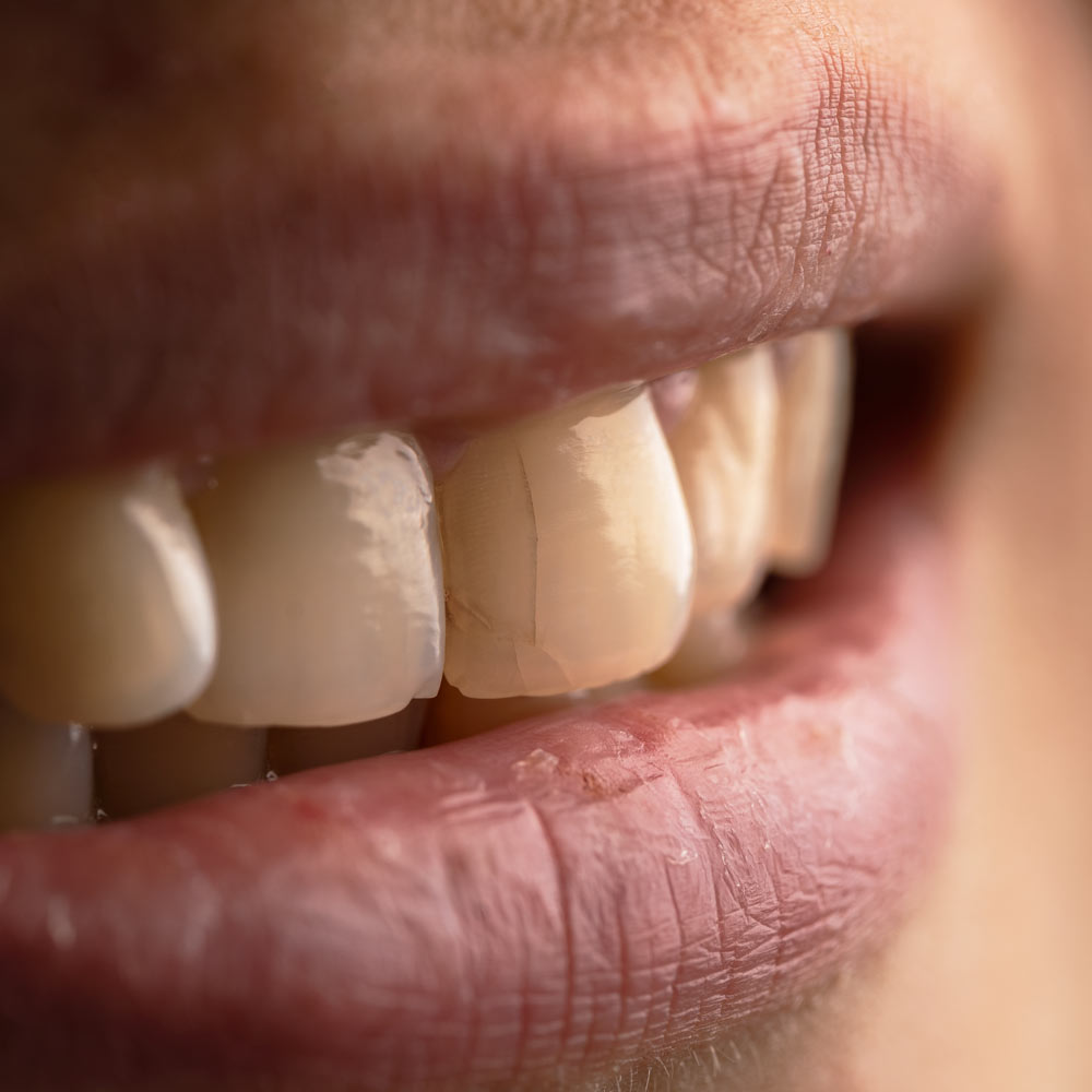 cracked tooth upclose