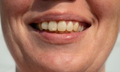 patient smiling with stained teeth