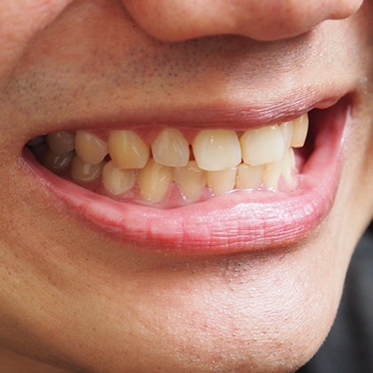 Stained yellow teeth