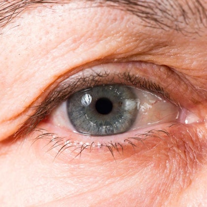 Eye with signs of aging