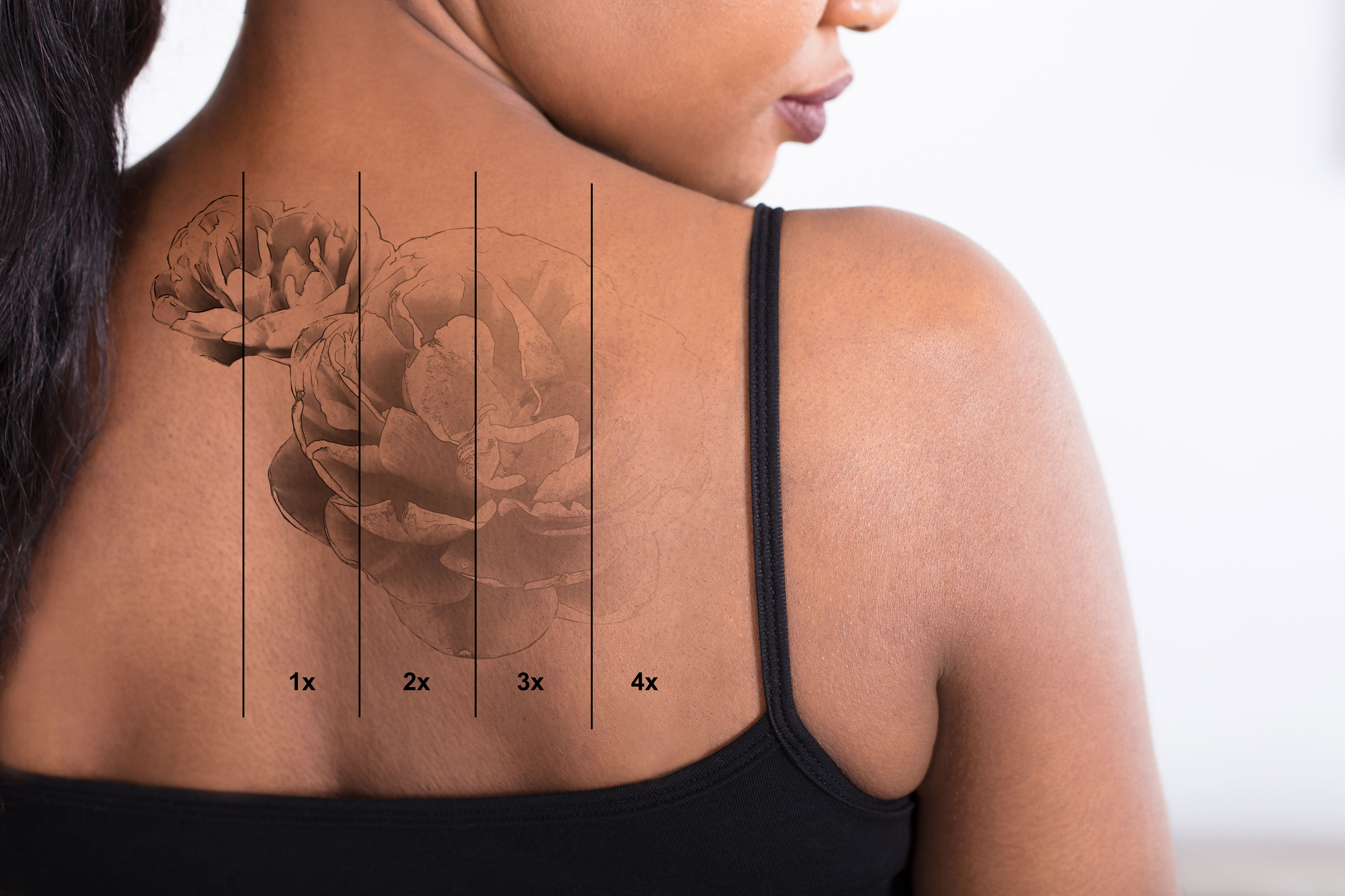 11 Sessions On (Full Back) | Tracking Maia Lee's Laser Tattoo Removal  Journey