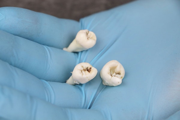 Extracted teeth being held by dentist in blue latex gloves