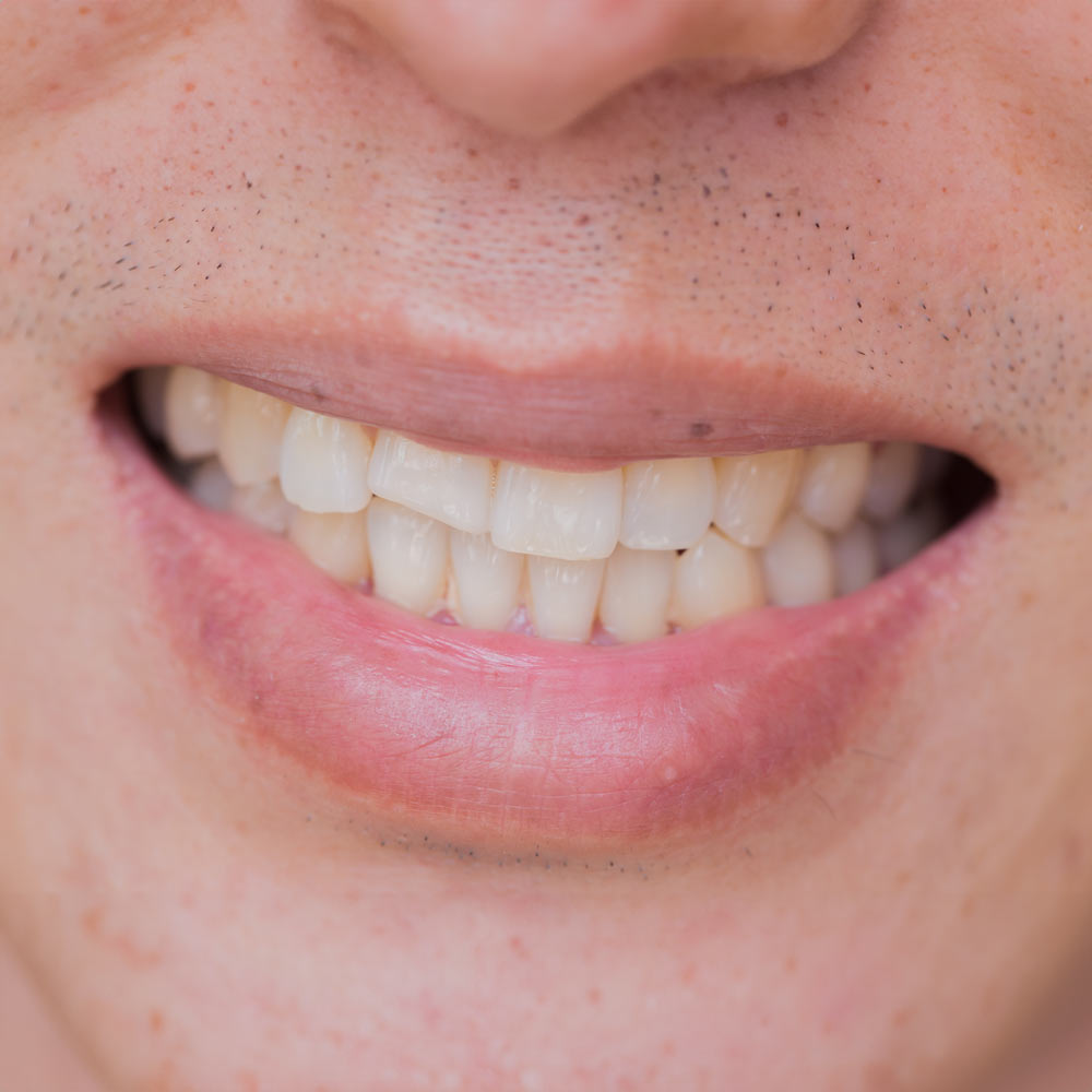 chipped front tooth in need of dental bonding