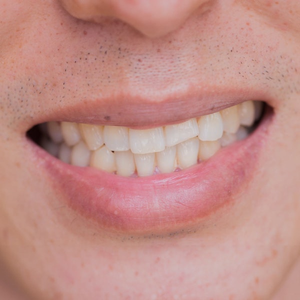 chipped front tooth in need of dental bonding