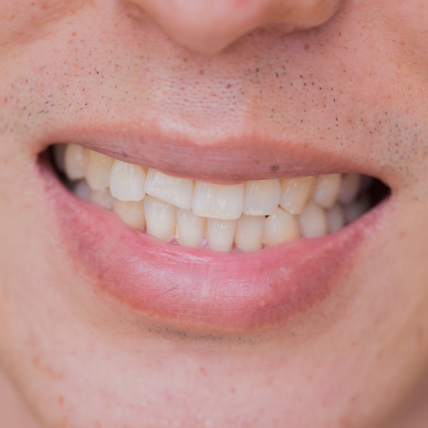 Man in need of dental bonding