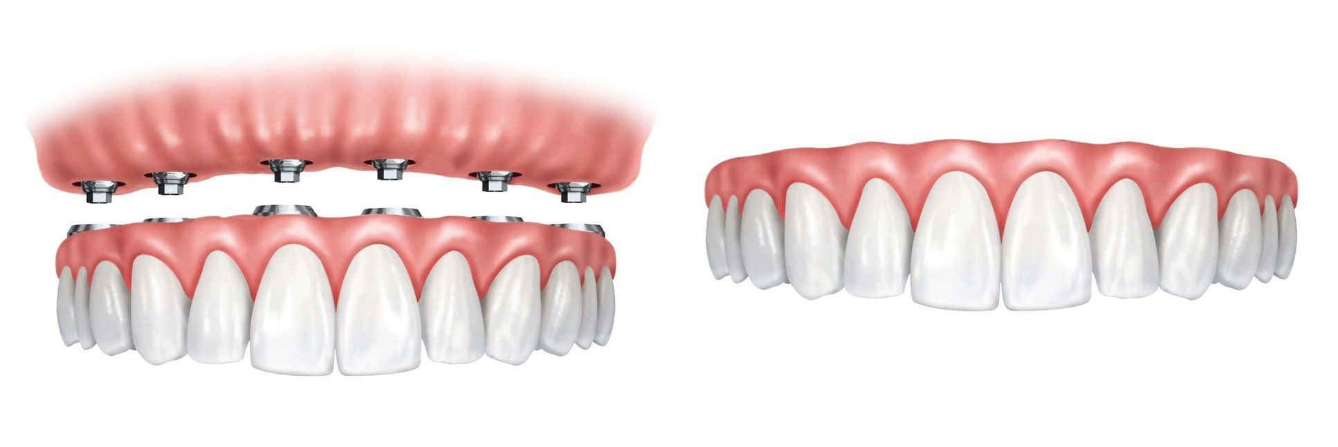 Implant Denture vs. Traditional Denture