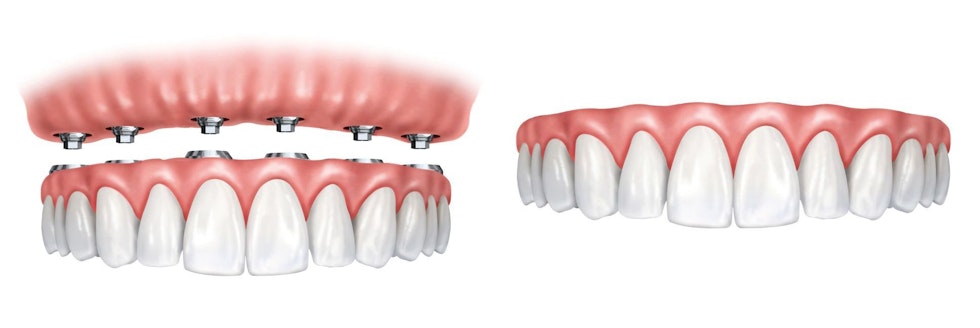 Side-by-side comparison of implant-supported dentures vs. traditional dentures.