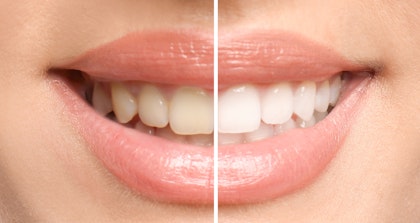 Before and after teeth whitening