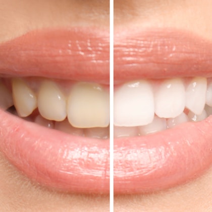 Before and after teeth whitening