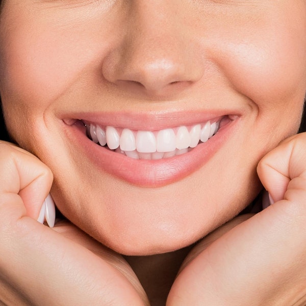 whitened smile makeover