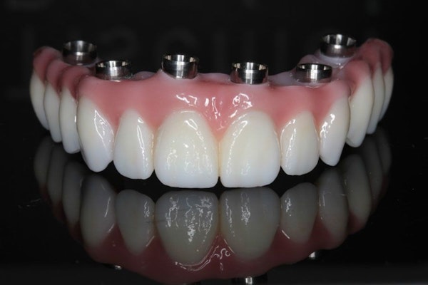 implant-supported dentures