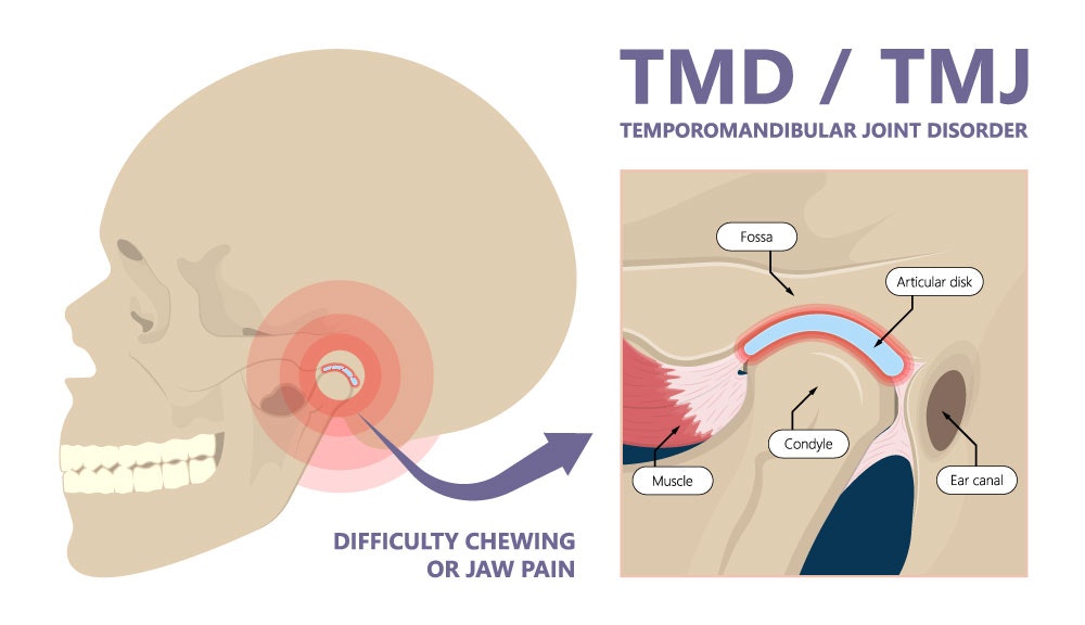 TMD / TMJ Temporomandibular Joint Disorder. Illustration showing that difficulty chewing or jaw pain can come from pain where the fossa and articular disk (connected to the muscle and ear canal) hits the condyle